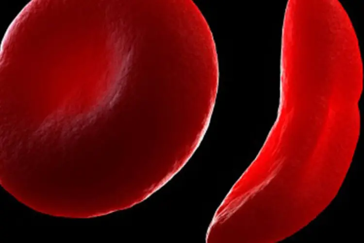 Anemia Falciforme: enzima responsável por restaurar o processo de ereção peniana está diminuída em camundongos com condição semelhante à doença (Getty Images)