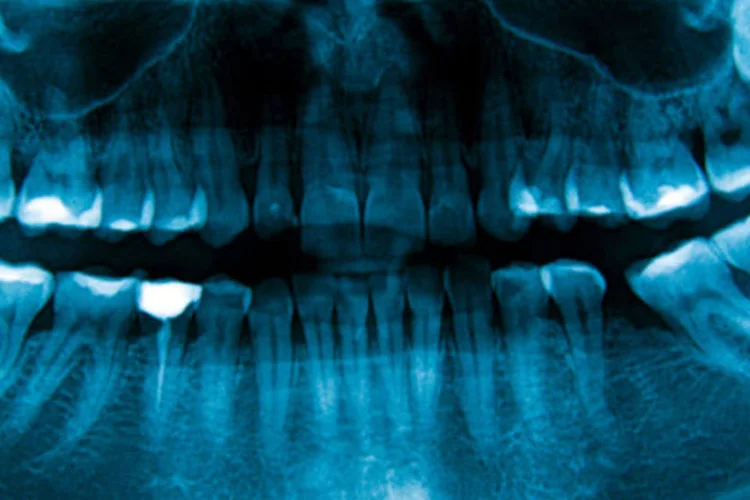 Odontologia: scanner lê e digitaliza imagens de raios X obtidas por meio de placas constituídas por sais de terras raras, entre outros materiais (Getty Images)
