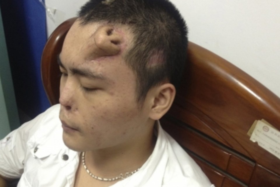 Médicos implantam nariz artificial na testa de paciente chinês
