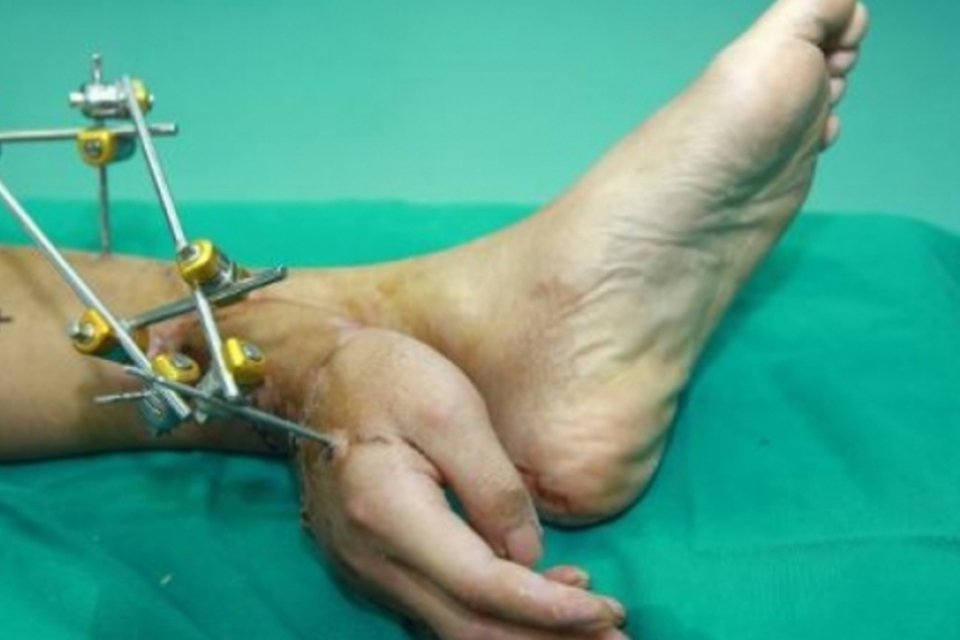 Mão de chinês é colada no tornozelo após acidente
