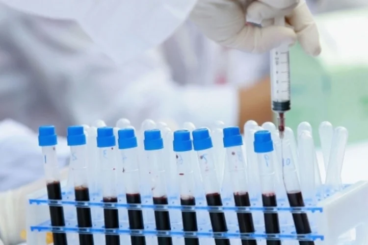 HIV: depois do tratamento, o vírus teria sido suprimido em cinco dos 24 pacientes que participaram do experimento (China Photos/Getty Images)