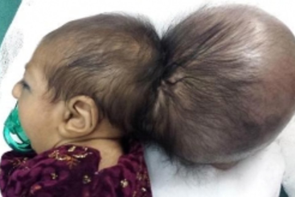 Médicos afegãos retiram "segunda cabeça" do crânio de um bebê