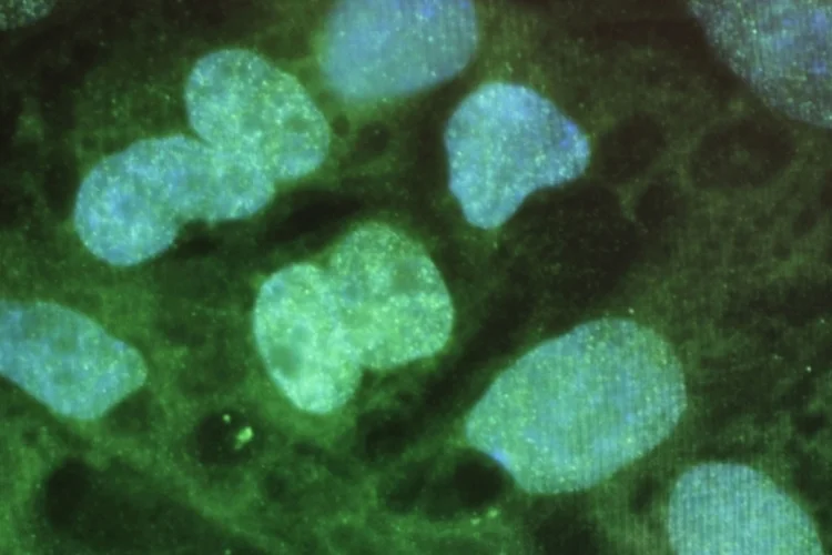 Células-tronco: células-tronco tumorais (ou cancerígenas) são células que podem se dividir e originar várias células que constituem tumores (Getty Images)