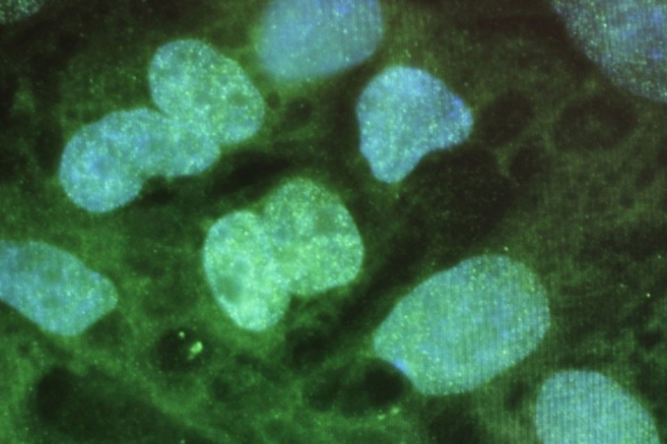 Células-tronco: células-tronco tumorais (ou cancerígenas) são células que podem se dividir e originar várias células que constituem tumores (Getty Images)
