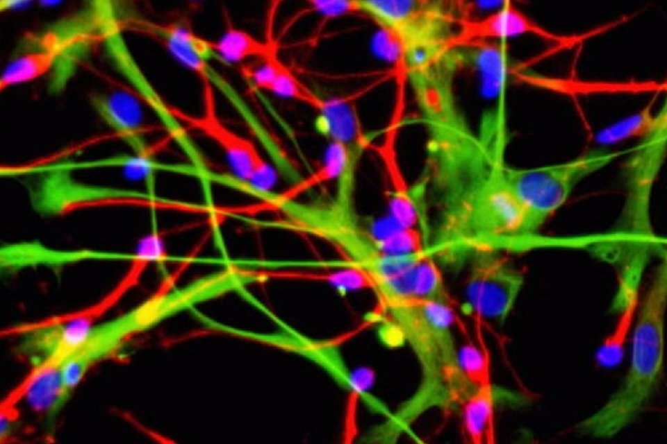 Para curar Alzheimer, cientistas transformam células da pele em neurônios saudáveis