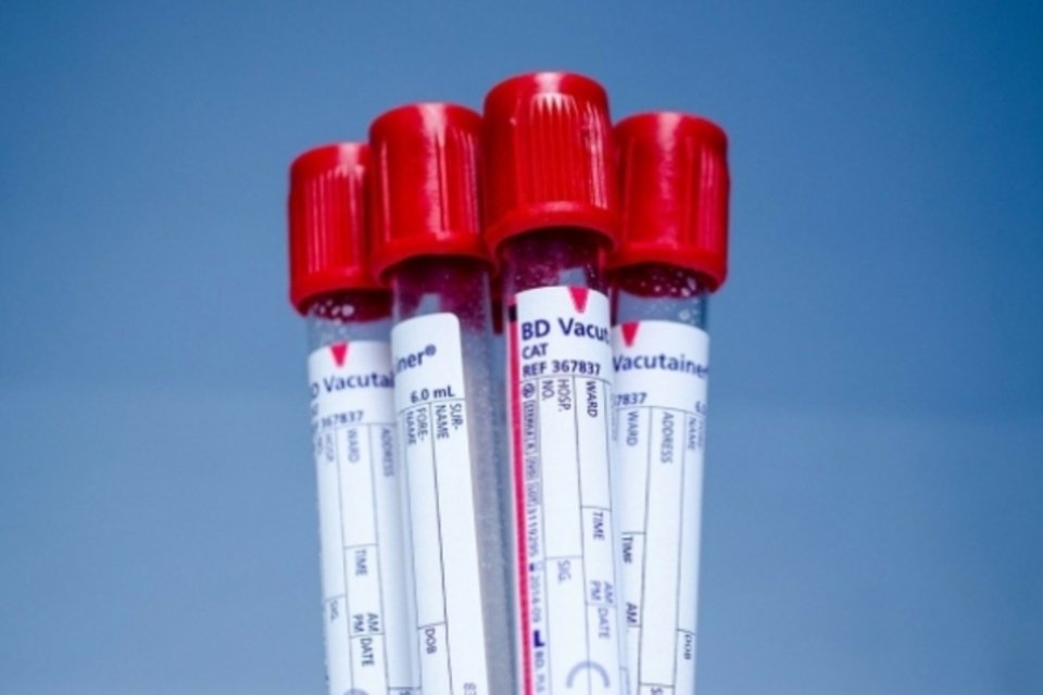 Teste de DNA no sangue é mais eficaz para detectar síndrome de Down