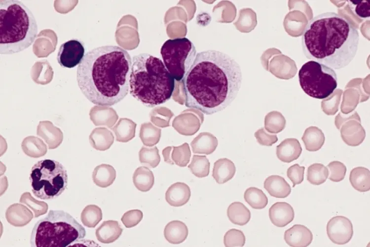 Leucemia (Wikimedia Commons)