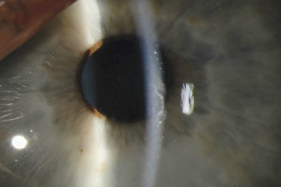 Médicos descobrem que Ebola pode sobreviver dentro dos olhos de pacientes