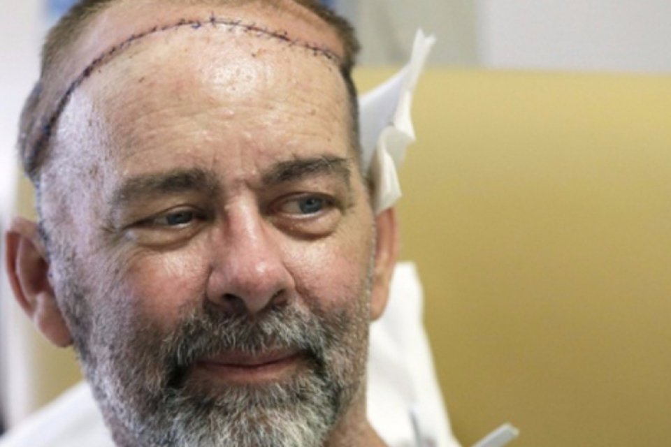 Americano recebe primeiro transplante de crânio do mundo