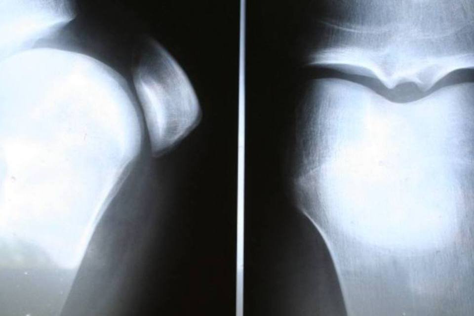 Entenda as lesões de ligamentos no joelho