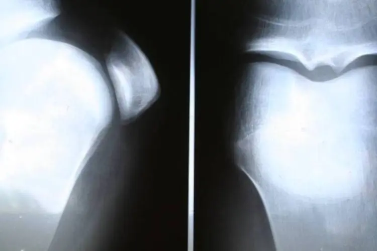 
	Exame de raio-x em um joelho: sintomas da doen&ccedil;a s&atilde;o dor, rangidos ou estalos na regi&atilde;o anterior do joelho
 (Stock.Xchange)