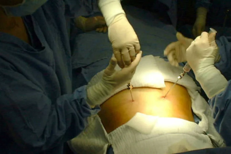 
	Cirurgia bari&aacute;trica: o novo texto indica o procedimento para pacientes com IMC maior que 35kg/mg, e n&atilde;o mais acima de 40kg/m&sup2;
 (Divulgação/ Direitos Reservados / Ag. Brasil)