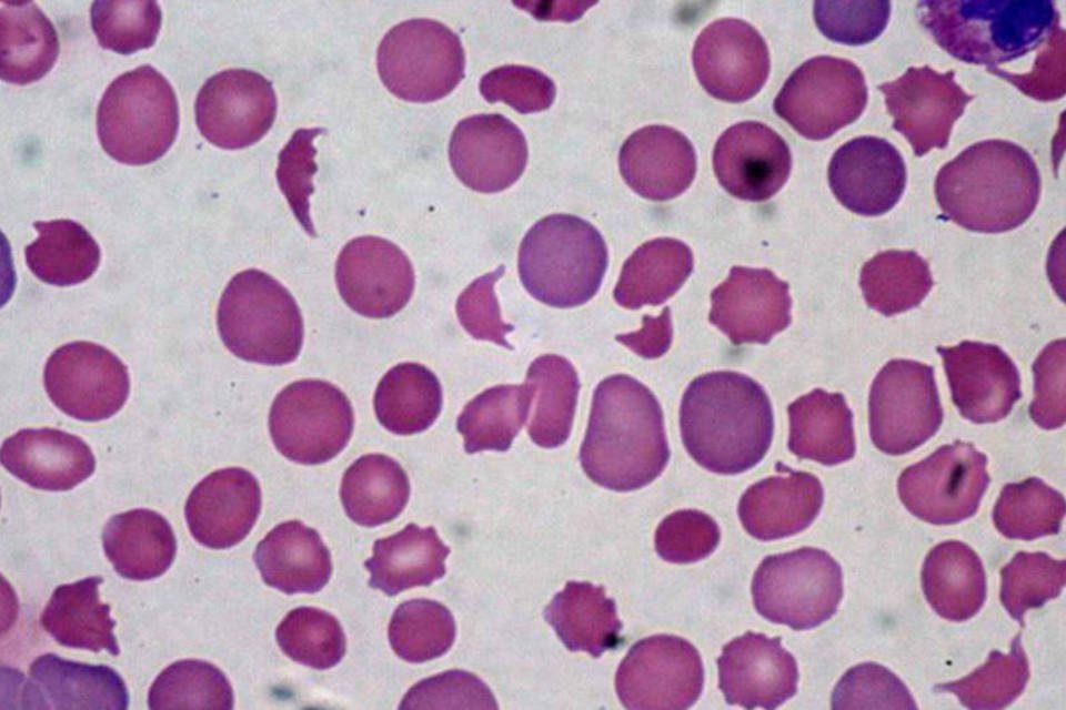 Anemia falciforme é problema cada vez mais grave, diz especialista