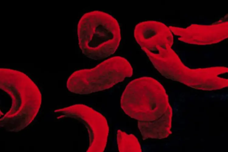 Anemia falciforme: essa alteração faz com que as hemácias – glóbulos vermelhos do sangue – assumam a forma de foice ou meia lua depois que o oxigênio é liberado (Getty Images)