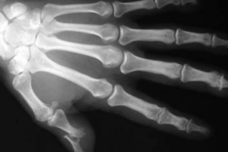 
	Artrite Reumatoide: pacientes apontaram a demora no diagn&oacute;stico e a falta de informa&ccedil;&atilde;o como maiores dificuldades no combate a doen&ccedil;a
 (Wikimedia Commons/Wikimedia Commons)