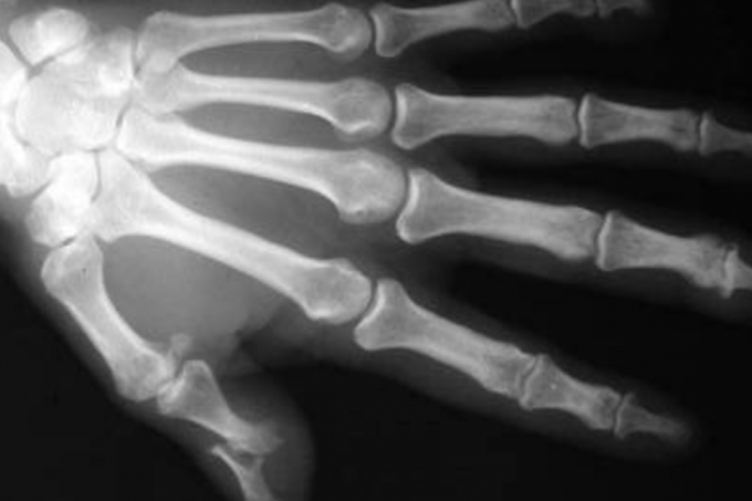 3 em cada 7 brasileiros com artrite não recebem diagnóstico