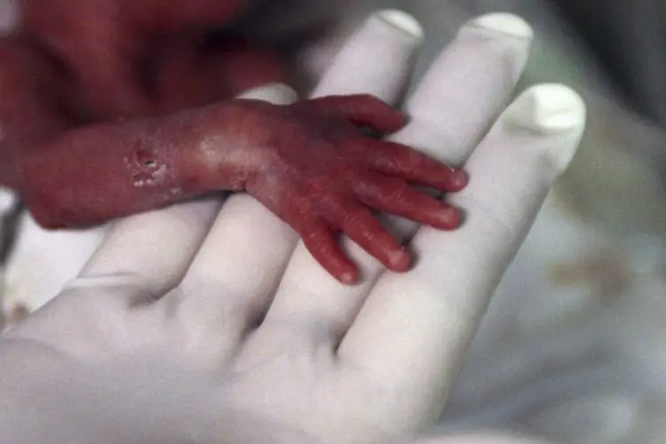 Prematuros: com um pulmão só funcionando, o bebê lutou bravamente pela vida (REUTERS/ Fredy Builes/Reuters)