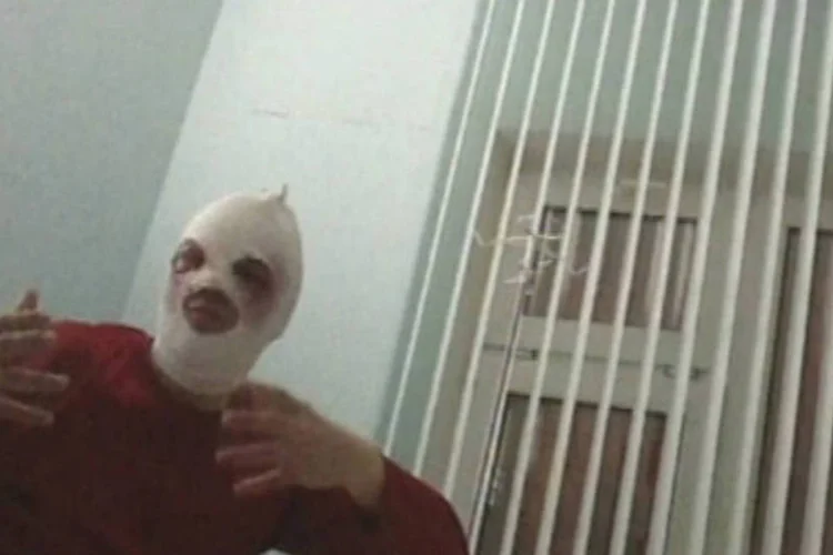 
	Sergei Filin ficou com queimaduras graves depois que um agressor mascarado jogou &aacute;cido sulf&uacute;rico no rosto dele, do lado de fora de seu apartamento, no dia 17 de janeiro
 (REUTERS / REN TV)