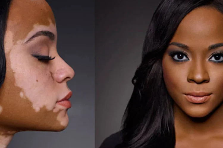 
	Frame de campanha Camo Confessions, da Dermablend: com vitiligo, professora Cheri Lindsay queria algo que tirasse o choque inicial das pessoas
 (Divulgação/Dermablend)