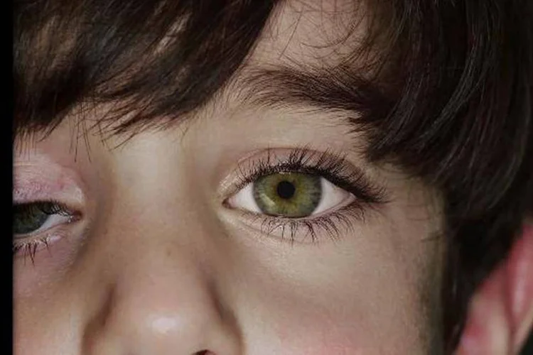 Câncer nos olhos em criança: Basta uma fotografia com flash e é possível conferir se há os sintomas do retinoblastoma (Reprodução)