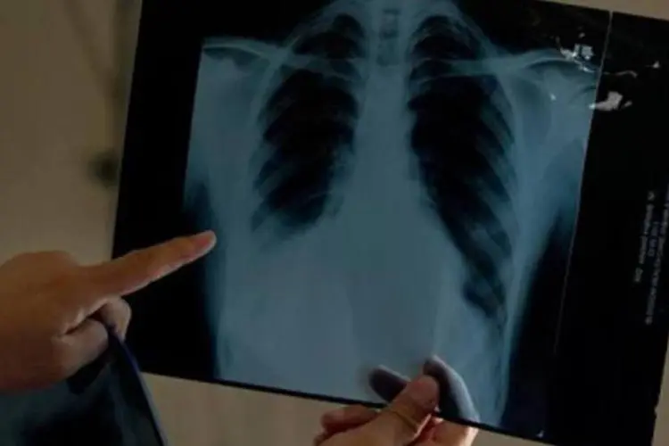 Tomografia dos pulmões é mais eficaz do que radiografia na detecção de tumores cancerígenos (Manan Vatsyayana/AFP)