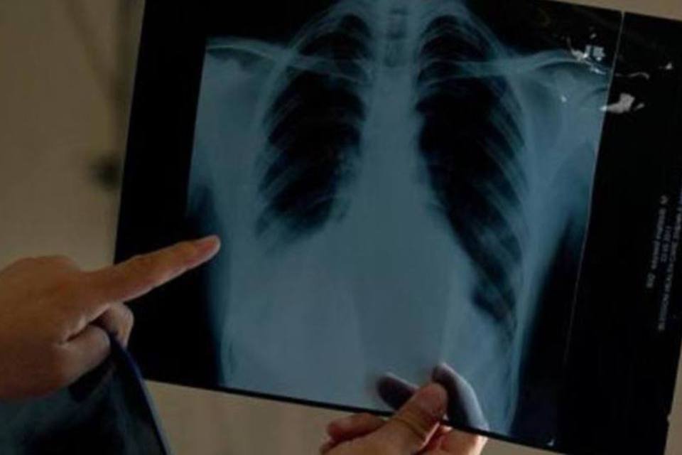Radiografia anual não reduz mortalidade por câncer de pulmão