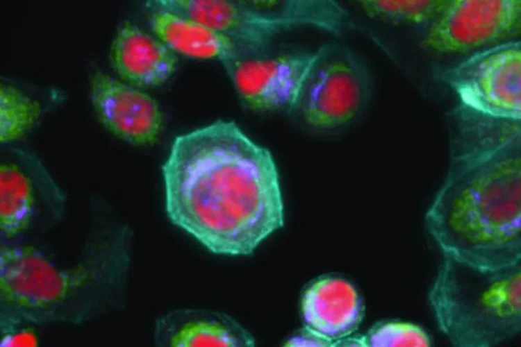 Células cancerígenas: de 85% a 90% dos casos estão relacionados ao estilo de vida, o que significa que mudanças de hábitos podem reduzir o risco de desenvolver a doença (Ge Healthcare/flickr)