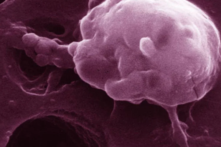 Câncer: a equipe tenta modificar a quimioterapia convencional, especificamente no combate ao câncer de pulmão (US National Cancer Institute/Divulgação)