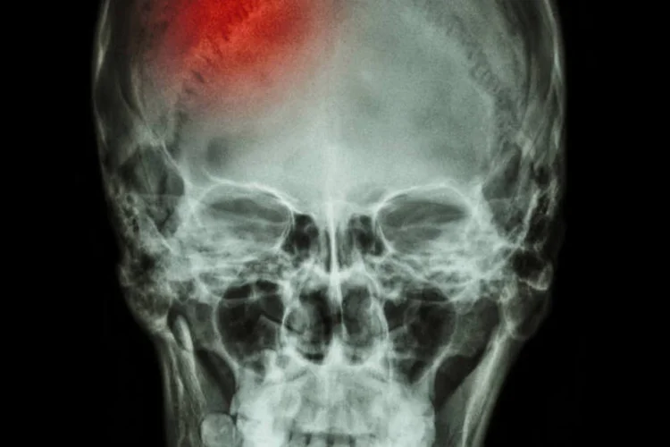 O anúncio foi feito na abertura do Global Stroke Alliance – for Stroke without Frontiers (Thinkstock/Thinkstock)