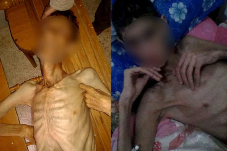 
	S&iacute;rios &agrave; beira da morte por inani&ccedil;&atilde;o na cidade de Mandaya, na S&iacute;ria
 (Syrian Observatory For Human Rights)