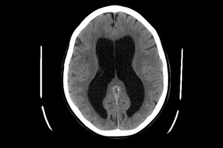 Hidrocefalia: bebês foram diagnosticados com acúmulo de líquido cefalorraquidiano  (Wikimedia Commons)