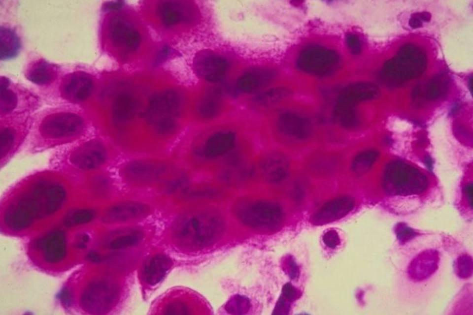 Câncer: novo dispositivo pode destruir células cancerígenas (Reprodução/Getty Images)