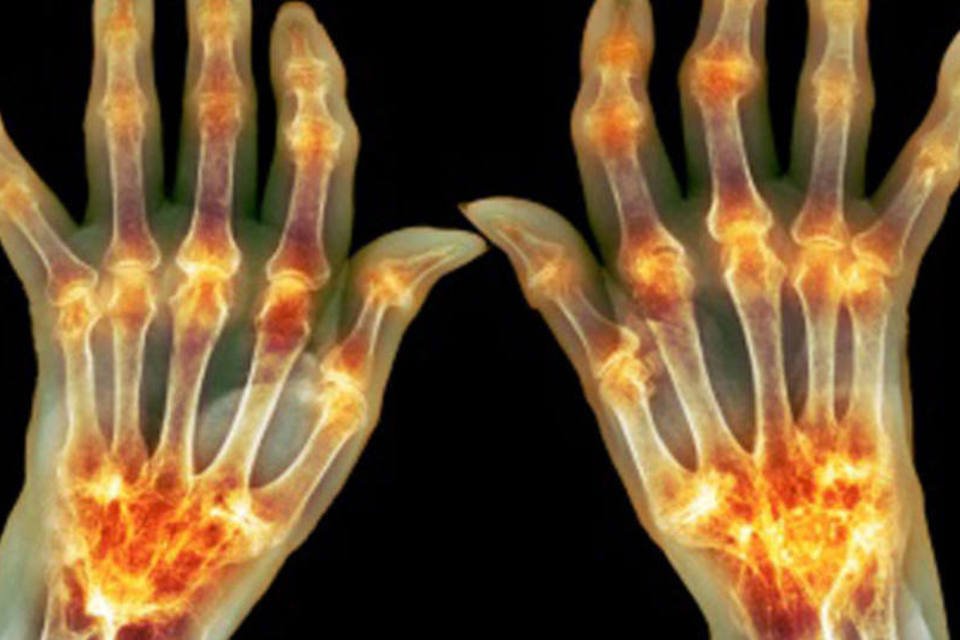 Identificados genes relacionados à suscetibilidade à artrite