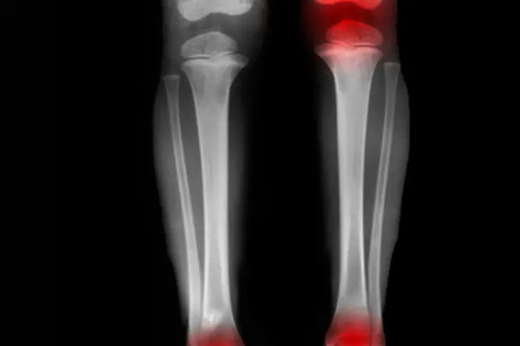 
	Perna com osteoporose: pessoas com osteoporose que j&aacute; tiveram fraturas t&ecirc;m risco muito maior de ter um segundo acidente, diz especialista
 (Peter Dazeley/Getty Images)