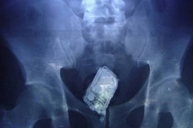 
	Radiografia de um prisioneiro escondendo um celular: o preso est&aacute; cumprindo uma pena de 10 anos por roubo na pris&atilde;o de seguran&ccedil;a m&aacute;xima de Welikada
 (AFP)