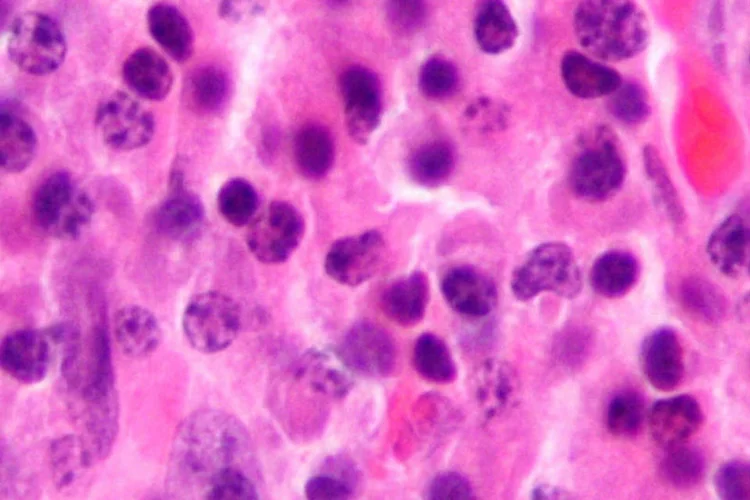 Em países mais pobres, deverão aumentar casos de cânceres ligados a infecções e, em países mais ricos, a obesidade e tabagismo (Nephron / Wikimedia Commons)