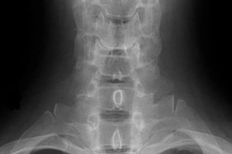 
	Profissional que trabalha muito tempo no computador est&aacute; sujeito a ficar com a tens&atilde;o muscular aumentada na regi&atilde;o do trap&eacute;zio e tamb&eacute;m desenvolver dores cervicais e at&eacute; de cabe&ccedil;a
 (Wikimedia Commons/EXAME.com)