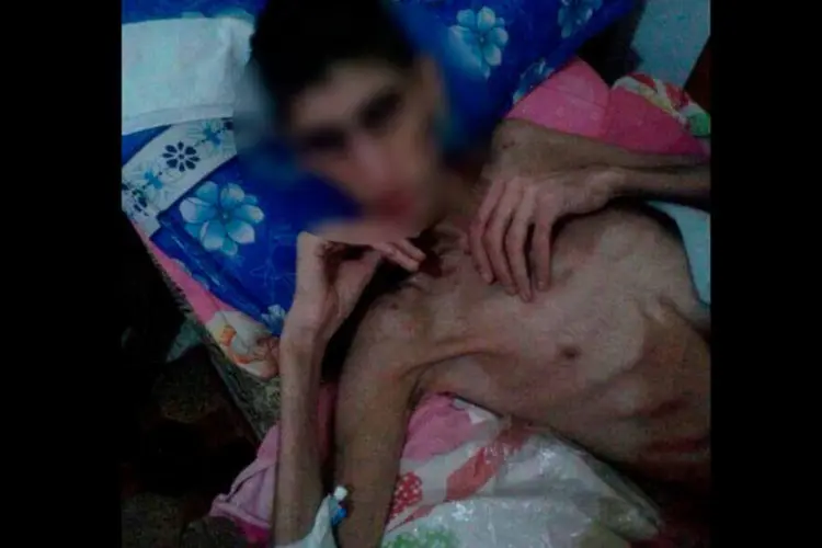 
	Foto de homem subnutrido na S&iacute;ria: os medicamentos tamb&eacute;m s&atilde;o escassos em Madaya
 (Syrian Observatory For Human Rights)