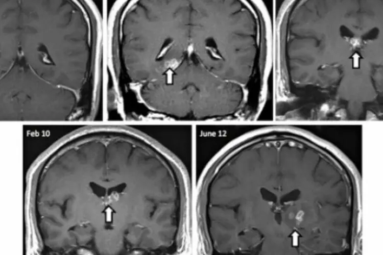 Tênia: pesquisadores querem entender como ela se alimentou dentro do cérebro do infectado (Divulgação/Hayley Bennett et al. Genome Biology 2014)