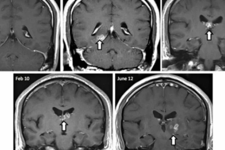 Tênia: pesquisadores querem entender como ela se alimentou dentro do cérebro do infectado (Divulgação/Hayley Bennett et al. Genome Biology 2014)