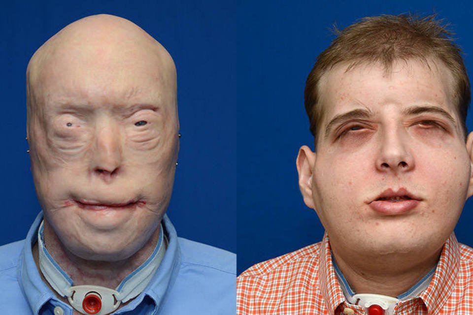 Homem recebe transplante de rosto mais extensivo da história