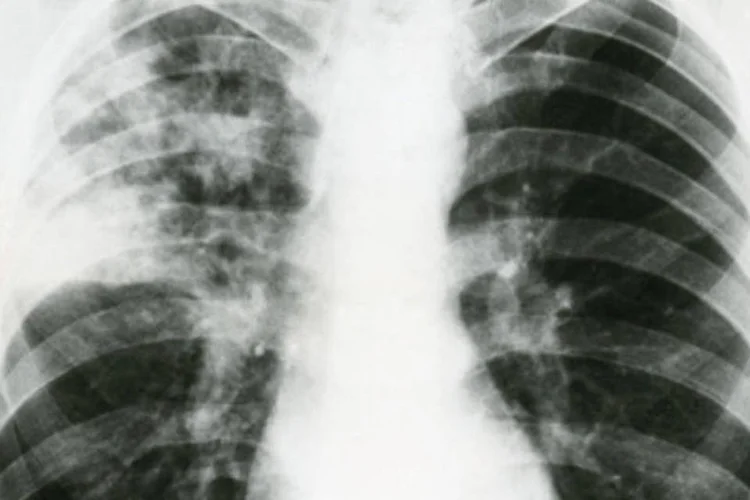
	Pulm&atilde;o com tuberculose: organiza&ccedil;&atilde;o apontou que 1,1 milh&atilde;o de pessoas morreram de tuberculose em 2014
 (Getty Images)
