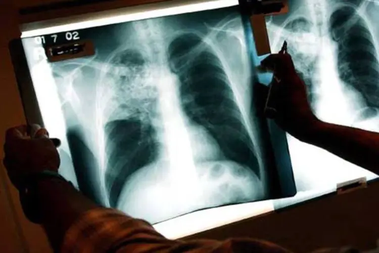 
	Raio X mostra pulm&atilde;o atacado por tuberculose: em 1990, a OMS estima que cerca de 10 mil brasileiros morriam anualmente pela doen&ccedil;a. Em 2012, o n&uacute;mero caiu para cerca de 4,9 mil
 (Spencer Platt/Getty Images)