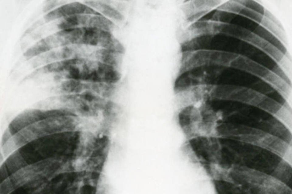 Estudo aponta alvo para o tratamento de tuberculose grave
