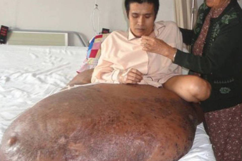 Tumor de 90 quilos é retirado com sucesso da perna de vietnamita