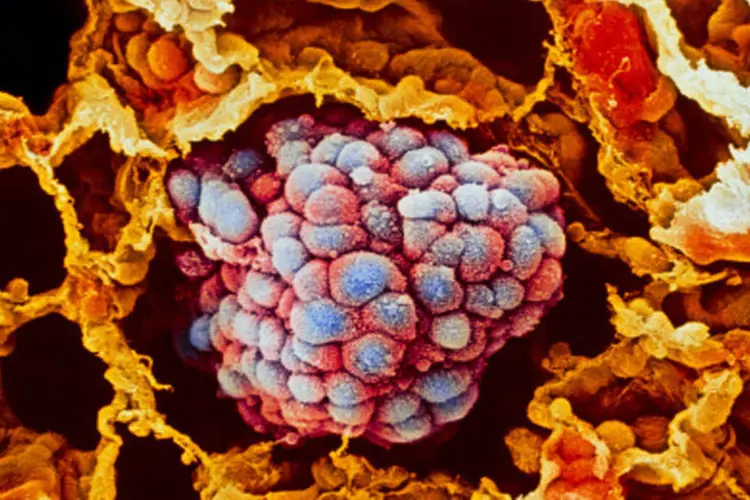 Falta de nutrientes desativa o maquinário de proliferação celular e faz com que as células tumorais adquiram um fenótipo invasivo (Getty Images/Getty Images)