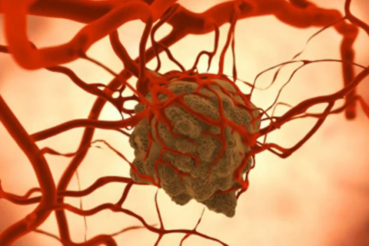 
	Tumor: taxa de sobreviv&ecirc;ncia para a doen&ccedil;a &eacute; de 70 a 80%, diz m&eacute;dico
 (Getty Images)