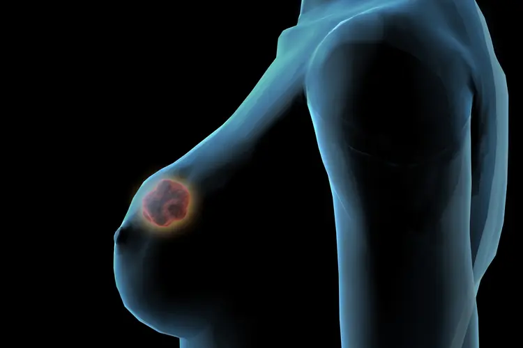 Projeto representa uma significativa mudança no processo da cadeia de análises da empresa, que emite 200 mil laudos de mamografia e ultrassonografia de mamas por ano (Reprodução/Thinkstock)