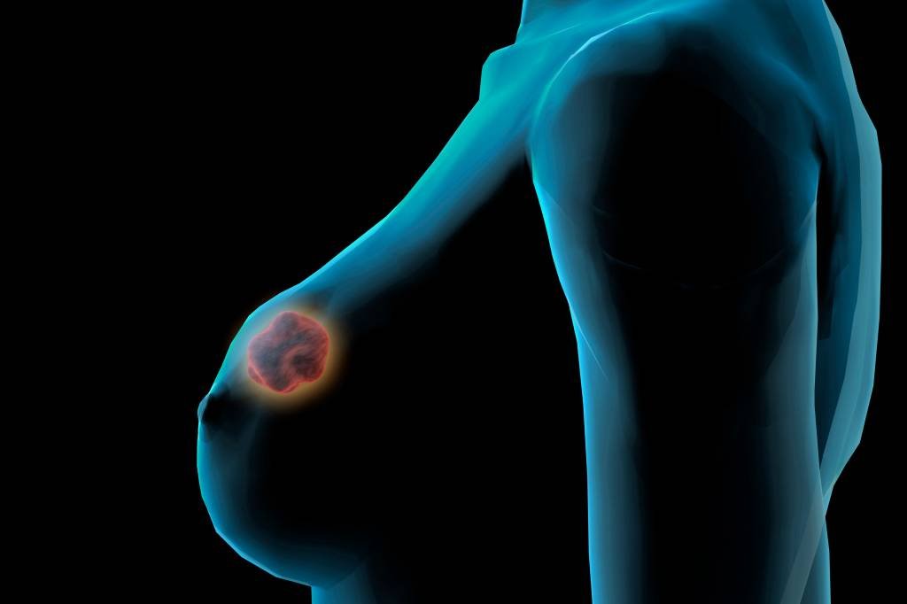 Projeto representa uma significativa mudança no processo da cadeia de análises da empresa, que emite 200 mil laudos de mamografia e ultrassonografia de mamas por ano (Reprodução/Thinkstock)