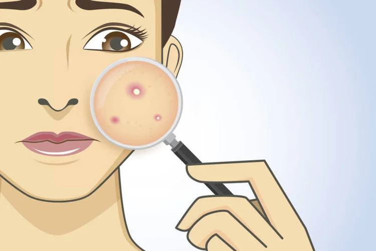 
	Acne: o segredo &eacute; uma estrutura cromoss&ocirc;mica chamada tel&ocirc;mero, uma esp&eacute;cie de capa que serve para proteger a pontinha dos cromossomos
 (ThinkStock)